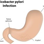 11 Remedios Caseros Efectivos Para La Infección Por Helicobacter Pylori